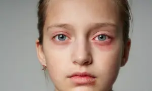 Dziecko z zaczerwienionymi, opuchniętymi powiekami i suchymi ustami. Uczulenie na twarzy - czym złagodzić?