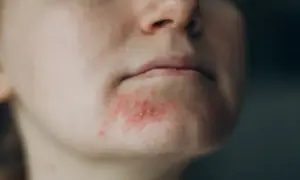 Skóra wokół ust zaczerwieniona, z widocznymi krostkami i suchymi łuskami. Objawy okołoustne zapalenie skóry.