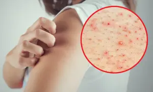 Dłoń drapiąca ramię, na którym widoczne są czerwone krostki. Powiększony fragment skóry ukazuje liczne drobne wypryski i włoski.