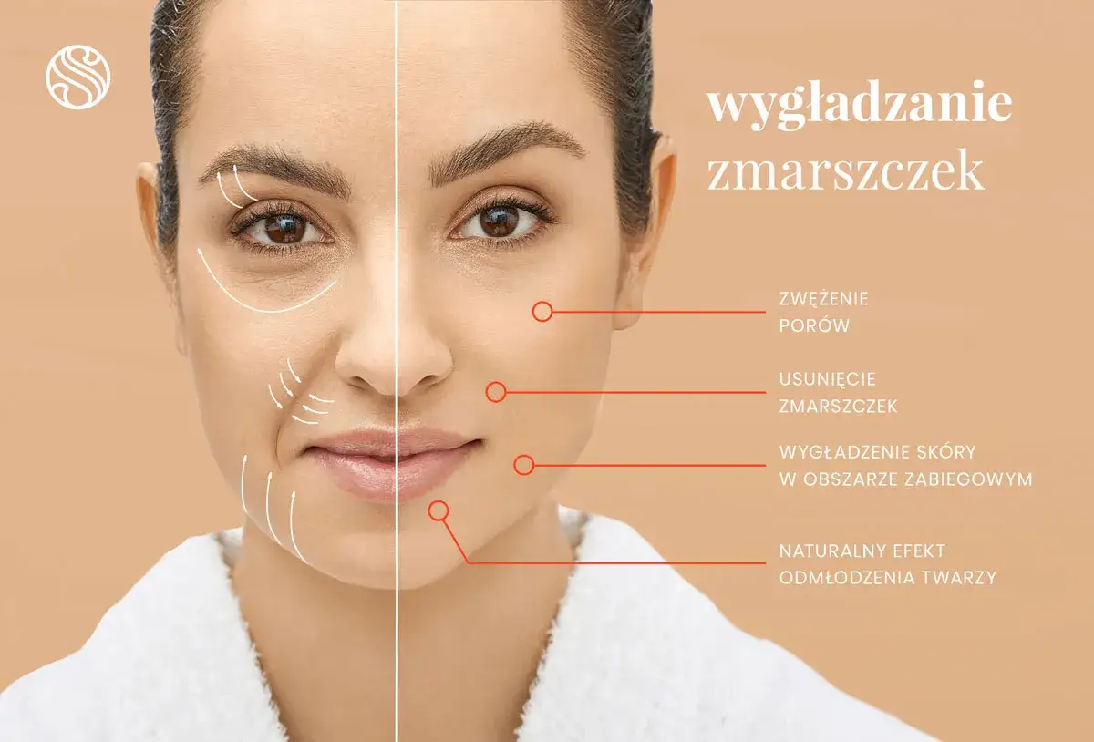 Kobieta z widocznymi zmarszczkami mimicznymi po jednej stronie twarzy, po drugiej wygładzona skóra. Efekty zabiegu: zwężenie porów, usunięcie zmarszczek.