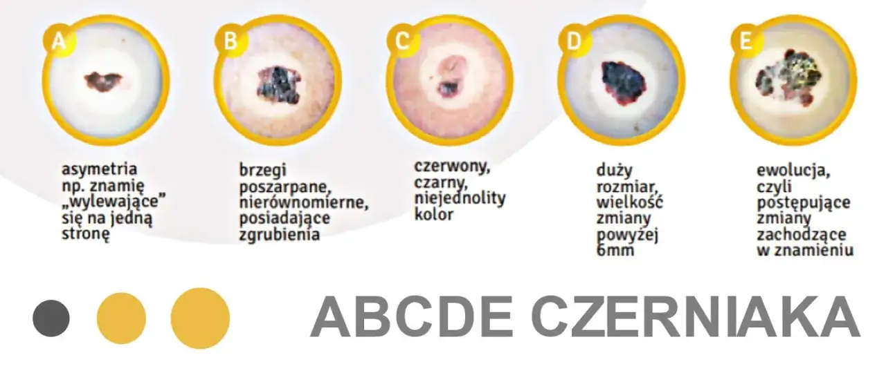 ABCDE - cechy czerniaka: asymetria, brzegi, kolor, duży rozmiar, ewolucja. Zwróć uwagę na swoje pieprzyki.